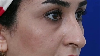 جراحی زیبایی بینی