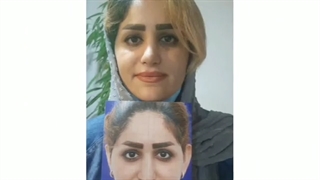 جراحی زیبایی بینی