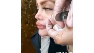 فیلم واقعی تزریق سیب گونه توسط دکتر امیرحسین پوریوسفی