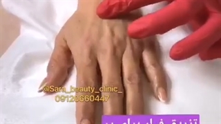 تزریق فیلر برای پر کردن و جوانسازی # 09120660447 پالپوتومی