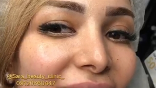 تزریق نخ کلاژن ساز