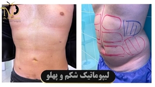 فیلم واقعی لیپوماتیک شکم و پهلو