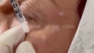 بوتاکس پنجه کلاغی