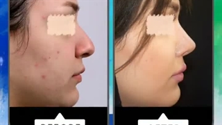 نمونه جراحی بینی ( 12 ماه بعد از عمل جراحی )