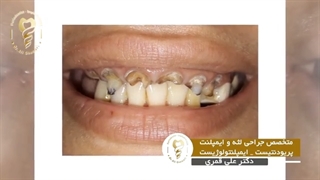 جراحی سینوس لیفت فک بالا به همراه بازسازی استخوان با پی ار اف