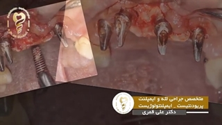 جراحی اکسپلنت(خارج کردن) ایمپلنت