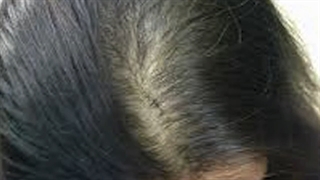 ریزش مو در خانم ها و آقایان