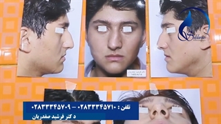 عمل انحراف شدید بینی