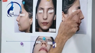 جراحی بینی در اتاق عمل با نتیجه عالی