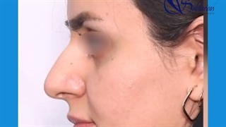 فیلم برداشتن قوز بینی