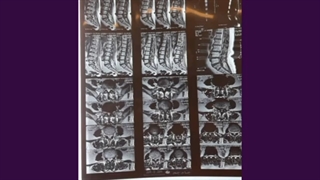 عمل خانم 71 ساله با تنگی شدید کانال کمری