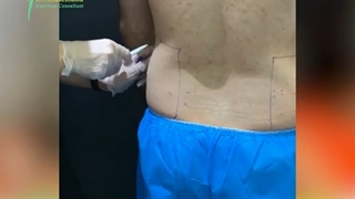 نتیجه درمان با اوندا برای مراجعه کننده عزیزمون بعد از یک جلسه در ناحیه شکم و پهلو