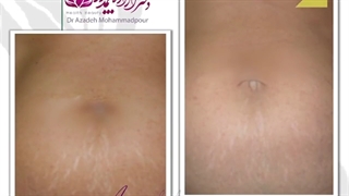 موضوع: رفع خطوط استرچ مارک