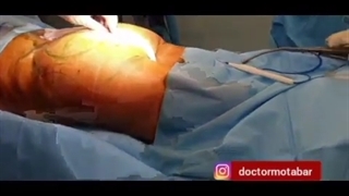 فیلم عمل پروتز و حجم دهی به باسن