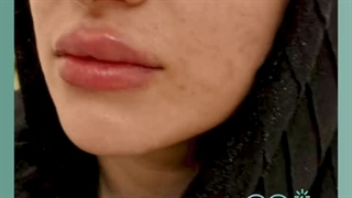 تزریق ژل لب روسی