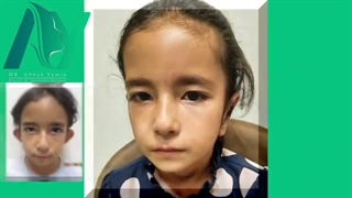 نمونه جراحی زیبایی اتوپلاستی (جراحی گوش)