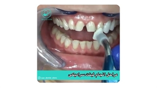 مراحل انجام لمینت سرامیکی