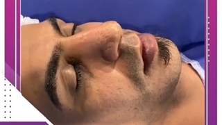 قبل و بعد از عمل بینی مردانه