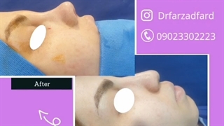فیلم واقعی و بدون سانسور بلافاصله بعد از عمل بینی
