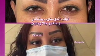 لیفت آندوسکوپ پیشانی و بلفاروپلاستی پلک بالا و پایین
