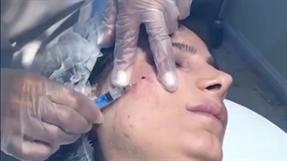 فیلم واقعی درمان جای جوش به روش سابسیژن