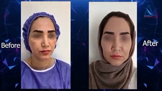 فیلم واقعی تزریق چربی به صورت و نتیجه فوق العاده