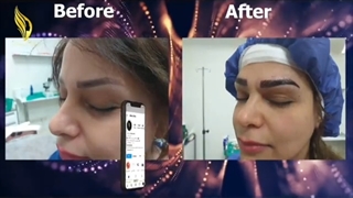 فیلم نمونه کار کاشت ابروی طبیعی