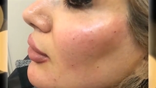 فیلم واقعی تزریق چربی و زاویه سازی صورت