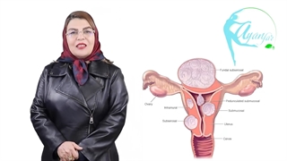 درباره فیبروم رحم چه میدانید؟