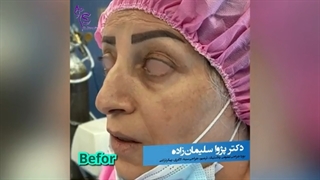 جراحی زیبایی بینی و پلک فوقانی