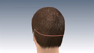 بهترین کلینیک کاشت مو در غرب تهران کجاست؟