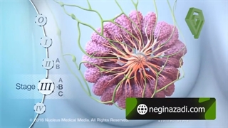 چگونه از سرطان سینه پیشگیری کنیم؟