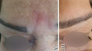 تزریق ژل خط اخم