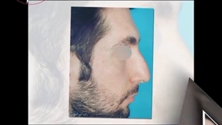 یکماه بعد از عمل بینی گوشتی غضروفی