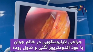 جراحی لاپاراسکوپی در خانم جوان
