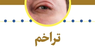 تراخم