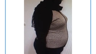 تصاویر قبل و بعد از عمل چاقی