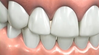 استریپ دندان ،متخصص ارتودنسی دکترعلیرضا خدیوی