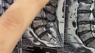 تومور نخاع توراسیک