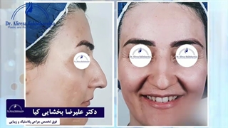 جراحی زیبایی بینی