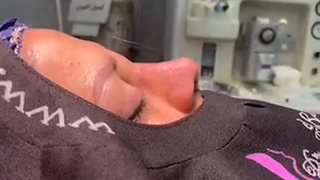 جراحی بینی ترمیمی