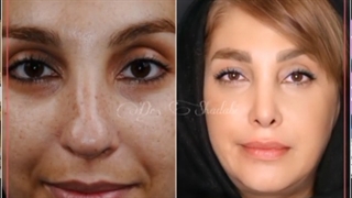 رضایت زیباجوی عزیز از جراحی بینی پس از 9 سال