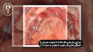 جراحی بازسازی فک بالا با 8 ایمپلنت