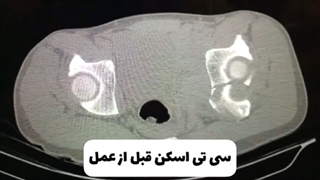 شکستگی حفره استابولوم