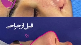فیلم واقعی قبل و بعد از جراحی بینی