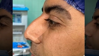 جراحی زیبایی بینی