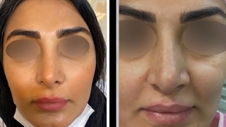 جراحی زیبایی بینی