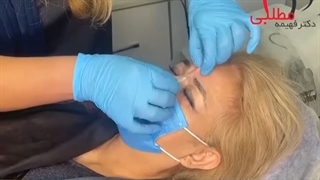 کارگزاری نخ برای برطرف کردن خط اخم