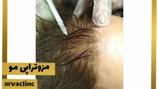 مزوتراپی مو