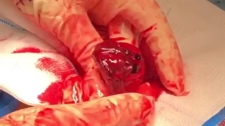 حاملگی خارج رحمی چیست؟